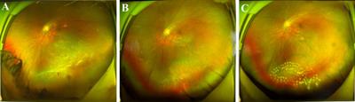 Efficacy and visual outcomes of the foldable capsular buckle scleral buckling in rhegmatogenous retinal detachment